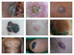 What does skin cancer look like? Skin Cancer Pictures Photos Pictures Of Skin Cancer