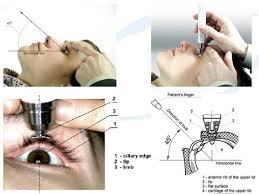 tonometry eye pressure test nyc eye