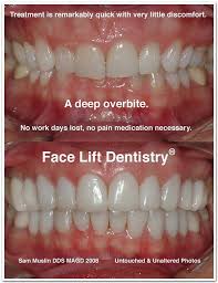 Regardless of how you acquired your overbite, your dentist can fix it for you. Pin By Apple Bright On Teeth Overbite Before And After Overbite Correction Overbite Braces