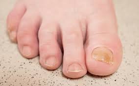 yellow nails symptoms causes and