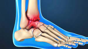 301 stem cell therapy for ankle pain