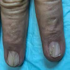 nail patella syndrome clinical clues