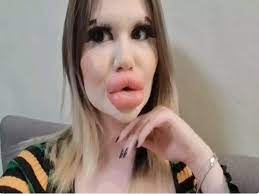 woman with the worlds biggest lips now