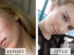 woman s before and after accutane