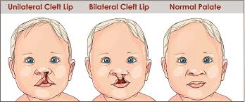 cleft lip or palate repair clinics in