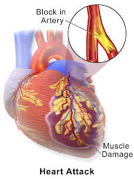 When myocardial injury persists, mi is the result. Myocardial Infarction Wikipedia