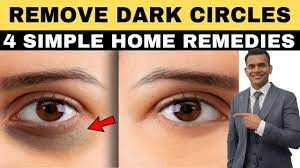 dark circles naturally