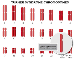 turner syndrome diagnosis treatment