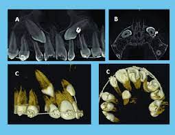 evaluation of impacted canine by cbct