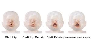 how many es are born with cleft lip