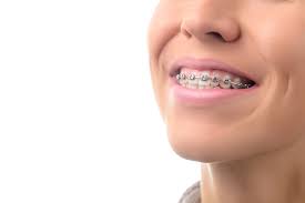 But, the average braces time to wear them is normally from 18 months to 2 complete years. 5 Signs You May Need Braces Belmar Orthodontics