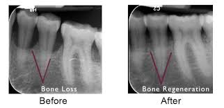 If you're in your early 20s or younger, congratulations! Bone Regeneration Periodontal Procedures