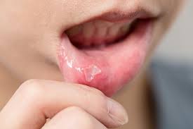 learn what s causing your canker sores