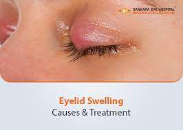 swollen eyelid treatment sankara eye