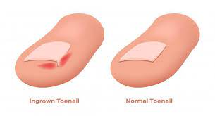 symptoms of an ingrown toenail