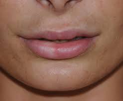 lip injection augmentation before