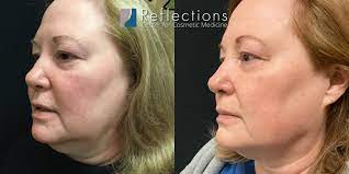 rosacea treated with vbeam laser
