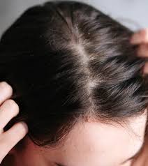 10 best home remes for dry scalp and