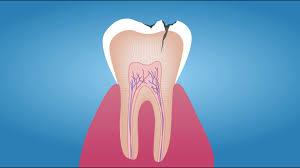 the tooth decay process how to reverse
