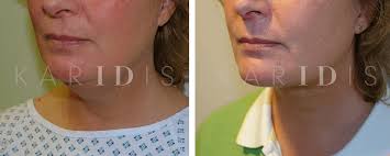 Maybe you would like to learn more about one of these? Liposuction Before After Results Uk Karidis