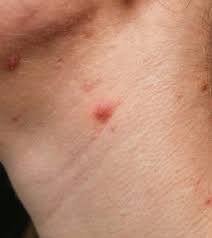 neck acne and home remes for pimples