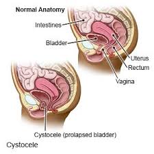 cystocele what you need to know