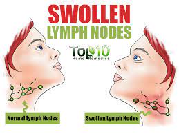painful and swollen lymph nodes in neck