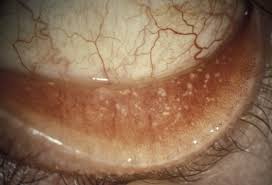 my eyelid conjunctival concretions