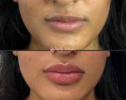 lip filler before after results