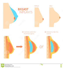 Breast Augmentation Infographics Stock Vector