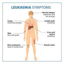 Symptoms Of Acute Lymphoblastic Leukemia Cancer gambar png