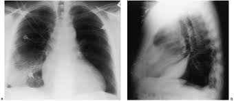 It can also be life threatening. Disease Of The Pleura Radiology Key