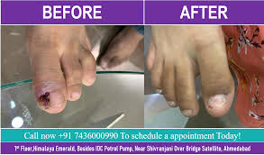 ingrown toenail removal surgery in
