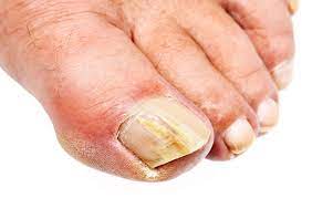 what causes toenail fungus how to