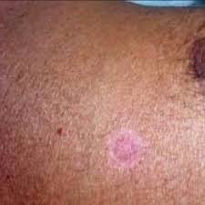 photograph of skin lesions showing disc