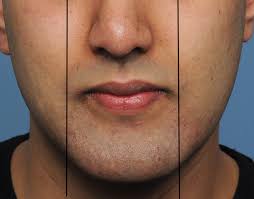 mouth widening surgery