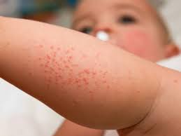 what causes baby acne babycenter