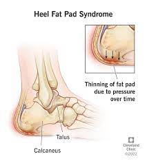 Heel Fat Pad Syndrome Symptoms Causes