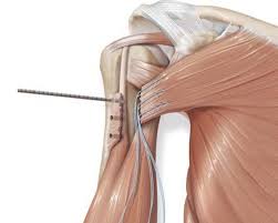 pec repair shoulder injuries dr