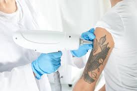 how does laser tattoo removal work