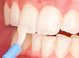 Because the body of the tooth is whiter, the areas of fluorosis staining are less obvious. Teeth Fluoride Treatment South Delhi India