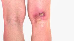 staph infection symptoms causes