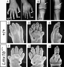nail patella syndrome gene lmx1b