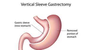 stomach removal sleeve gastrectomy