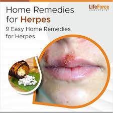 9 easy home remes for herpes