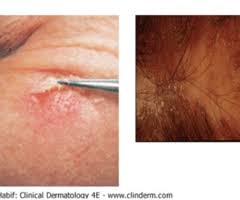 inflammatory lesions of skin flashcards