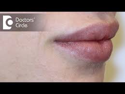 causes of white spots on lips dr