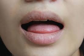 dry mouth causes symptoms and remes