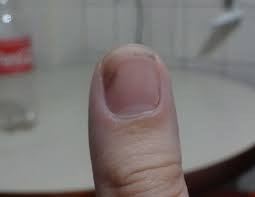 the mystery of nail pitting