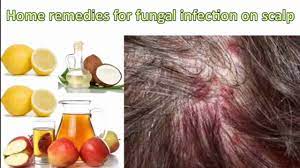 home remes for fungal infection in